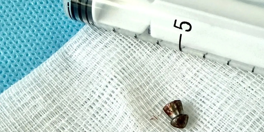 Приморские хирурги извлекли из лица подростка пулю от «воздушки»