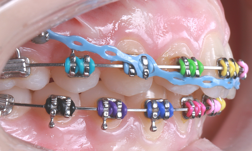 Носители бреккетов часто нуждаются в особой гигиене за зубами, на фото видно скопление темного налета вокруг самих брекетов, резинок.