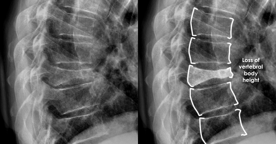Взято из открытых источников.  Значительно уменьшена высота тела одного из позвонков с клиновидной его деформацией. Это компрессионный перелом  грудного позвонка