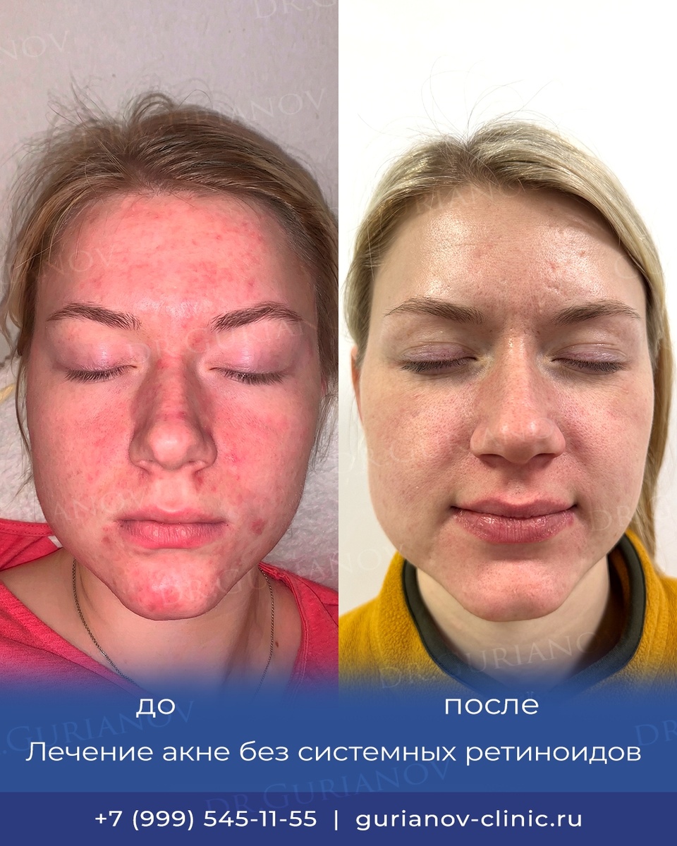 https://gurianov-clinic.ru/akne