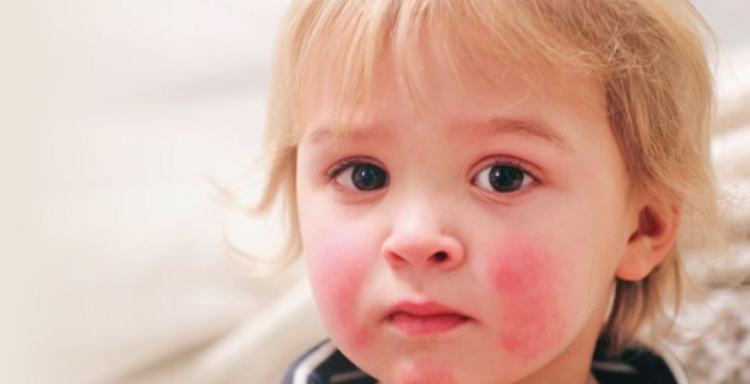 Инфекционная эритема: что нужно знать родителям