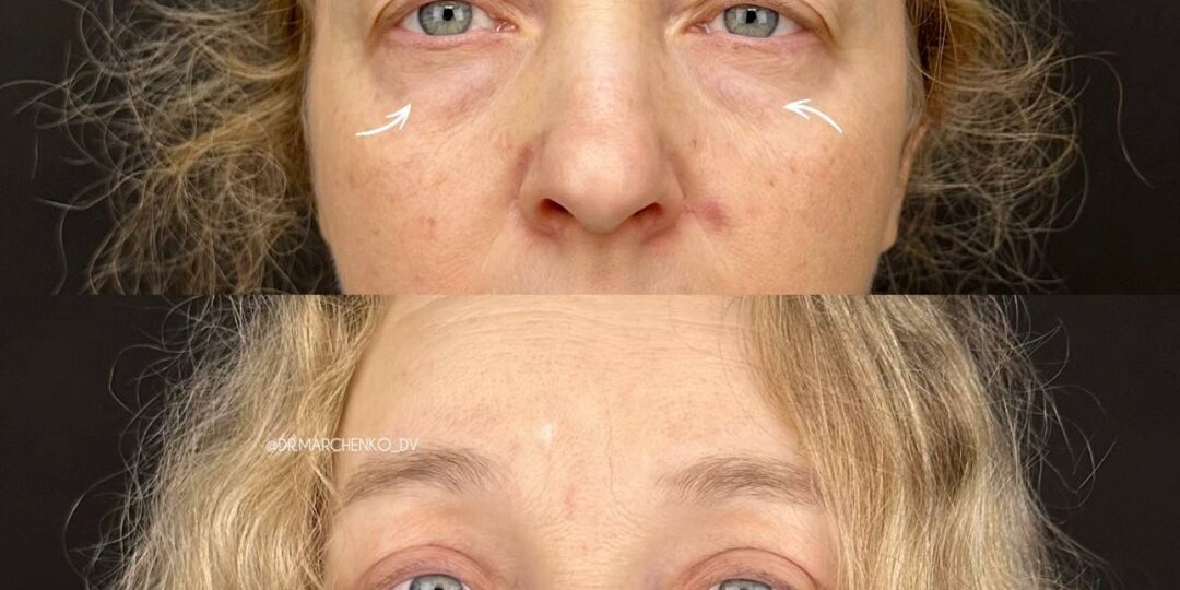 ✨ 1,5 месяца после пластики верхних и нижних век (круговой блефаропластики
