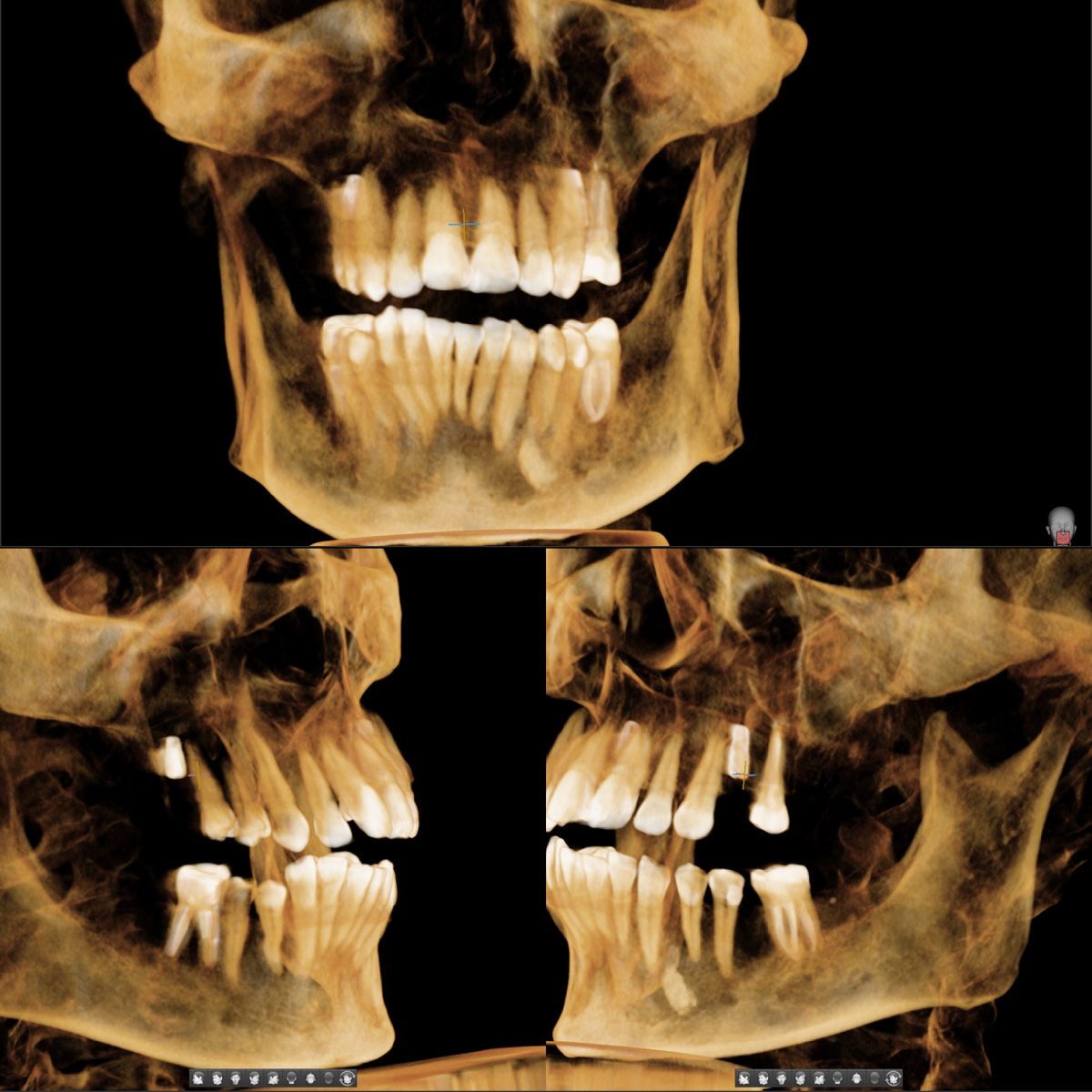 КТ с имплантатами, установленными в Parodent - забегая вперед