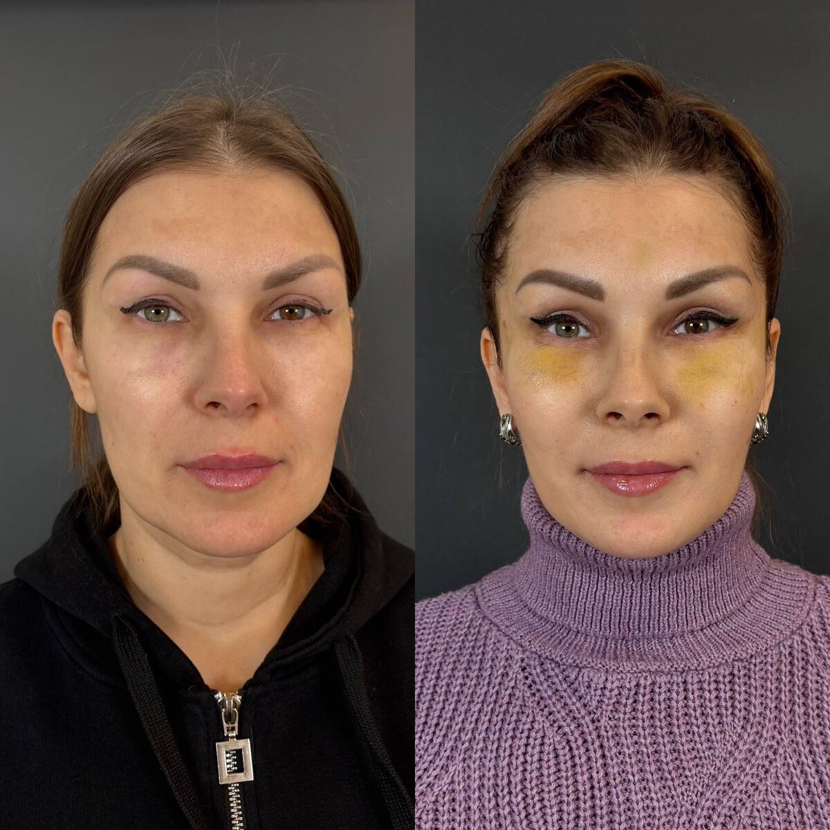 Эндоскопический лифтинг лица: 11-е сутки после операции (слева- до, справа- после). Хирург Остринская Т.В.