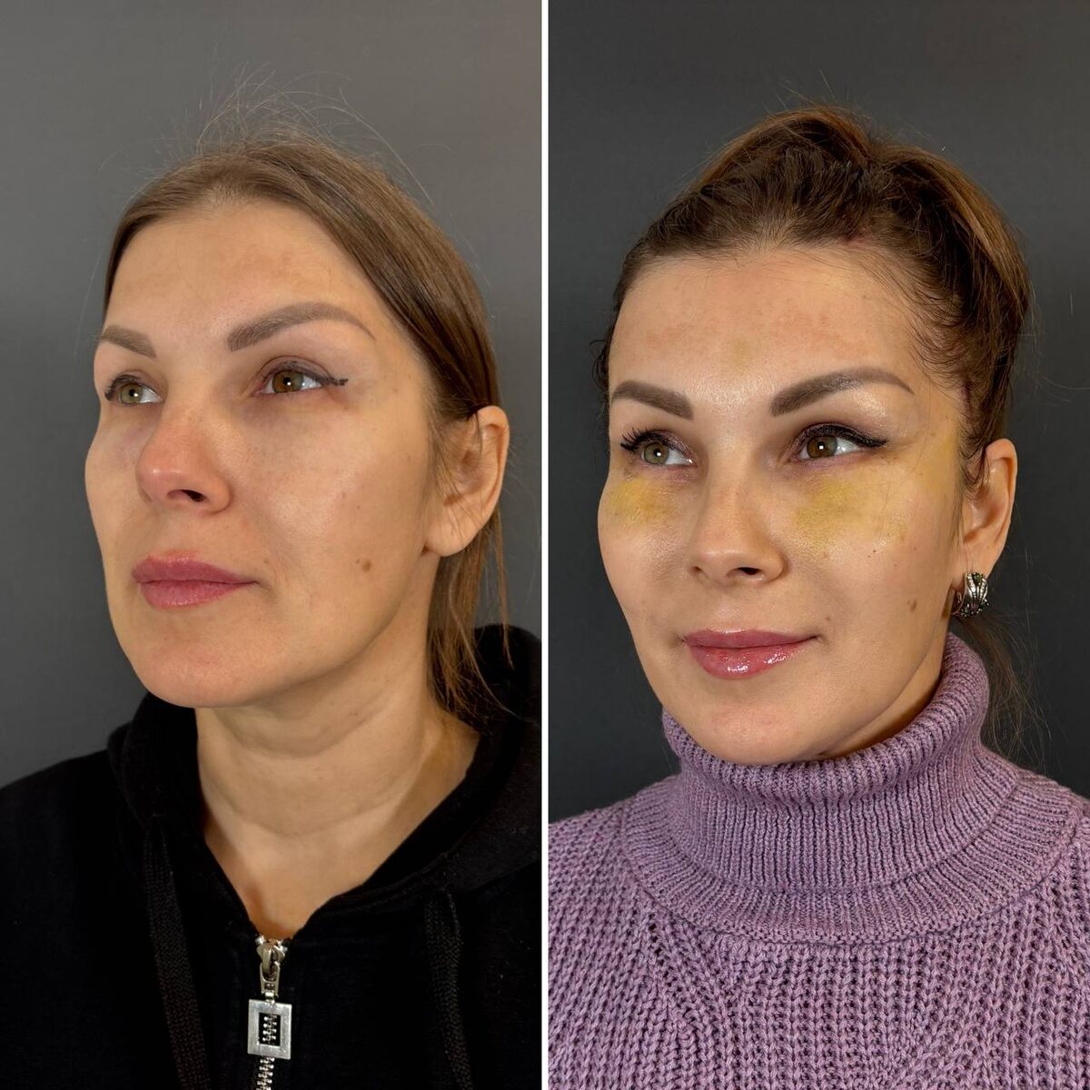 Эндоскопический лифтинг лица: 11-е сутки после операции (слева- до, справа- после). Хирург Остринская Т.В.