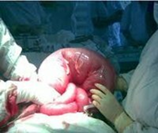 Операция по восстановлению движения содержимого по кишечнику резекцией нежизнеспособного участка кишки.