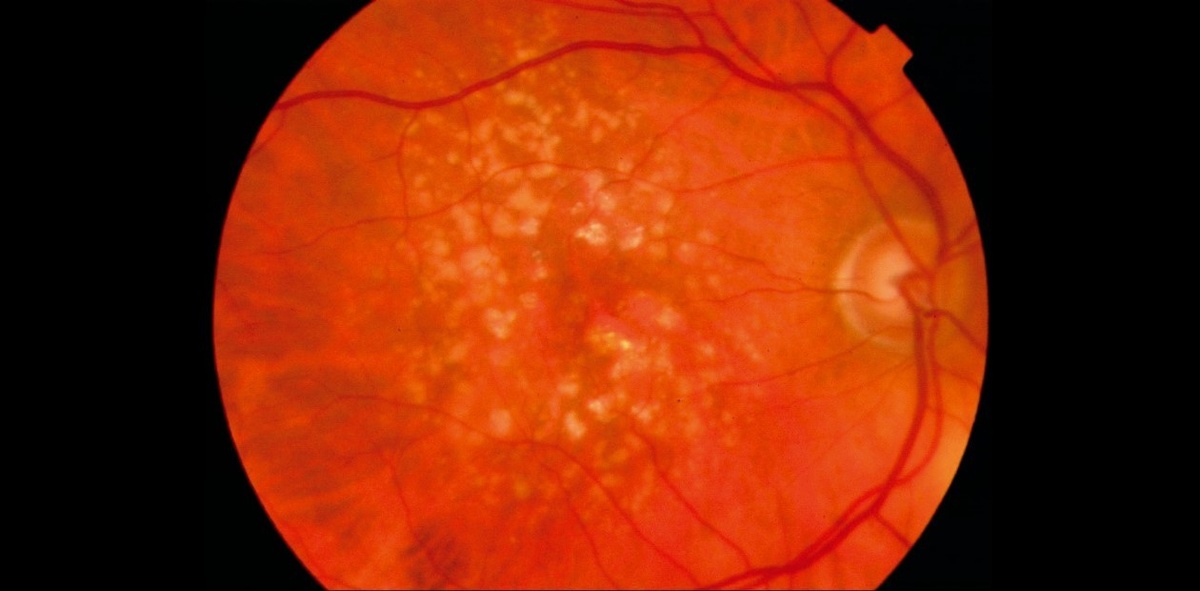 Возрастная макулодистрофия, сухая форма. © CC BY-NC 2.0/Richard Leung