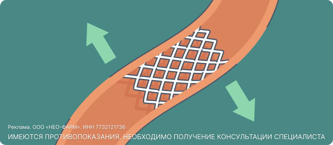 «Зонтик» в сердце: как проводят стентирование сосудов