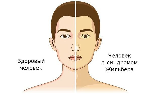 Синдром Жильбера. Что я сделала в первую очередь, когда получила подтвержденный результат анализа на руки