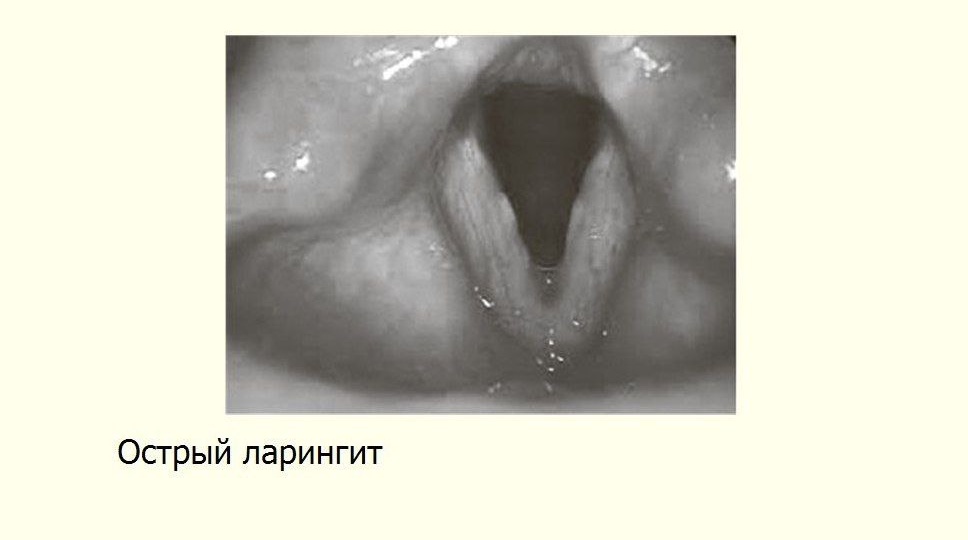 Не стоит на каждый случай осиплости голоса - использовать ПУЛЬМИКОРТ