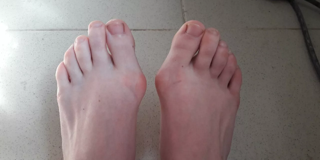 Боитесь операции на косточке? Зря. Как я избавилась от “шишки” за 30 минут и без наркоза