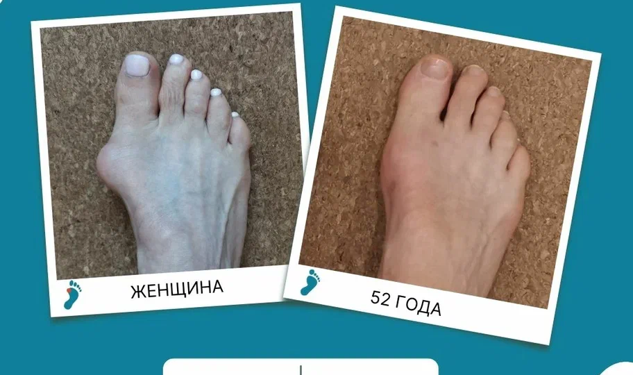 Почему болят стопы и что с этим делать? Гайд от хирурга-ортопеда Красильникова С.Н