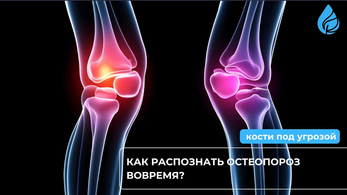 Остеопороз без симптомов: как понять, что кости теряют плотность?