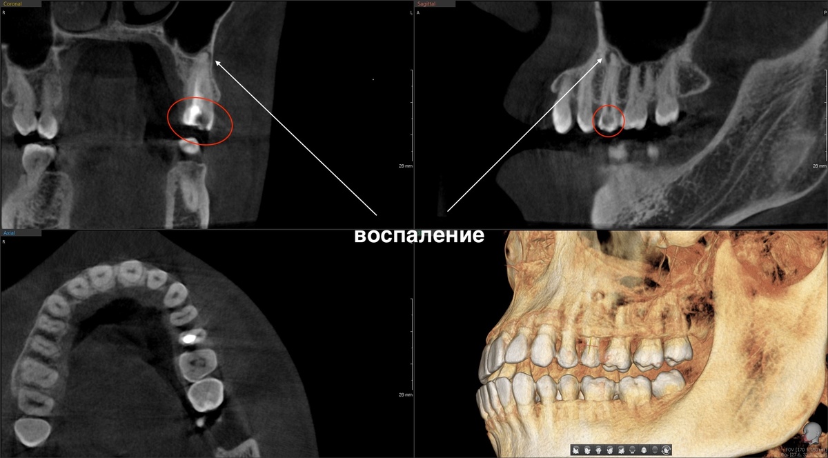 Красный круг- кариес, периодонтит 2.5 зуба