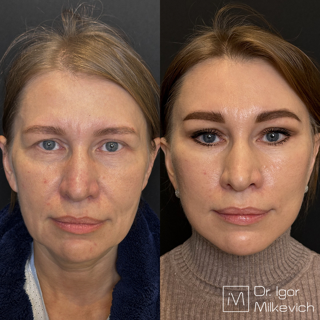 2 месяца после круговой подтяжки лица