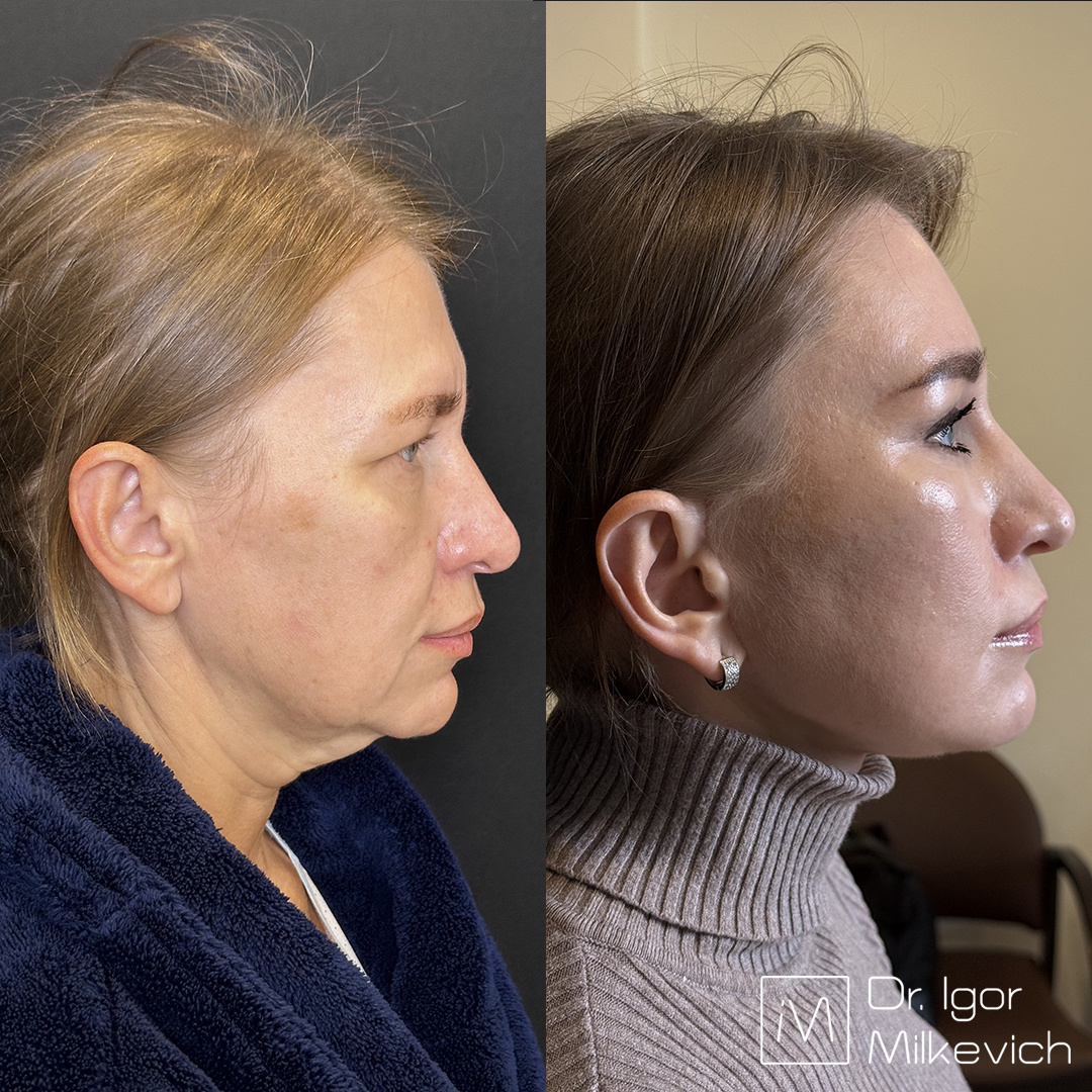 2 месяца после круговой подтяжки лица