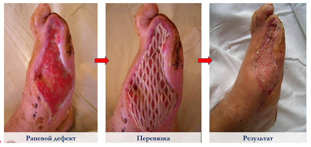 При менение современных высокотехнологичных перевязочных средств при синдроме диабетической стопы
