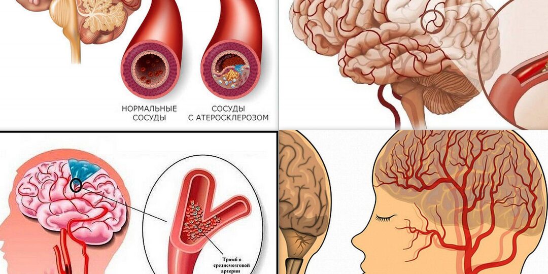 5 признаков, что сосуды мозга начинают терять эластичность