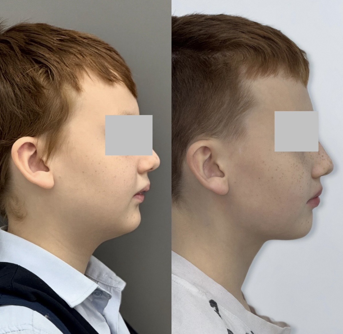 На фото: примеры из практики коррекции дистального прикуса Ксении Пиксайкиной-Григорьевой