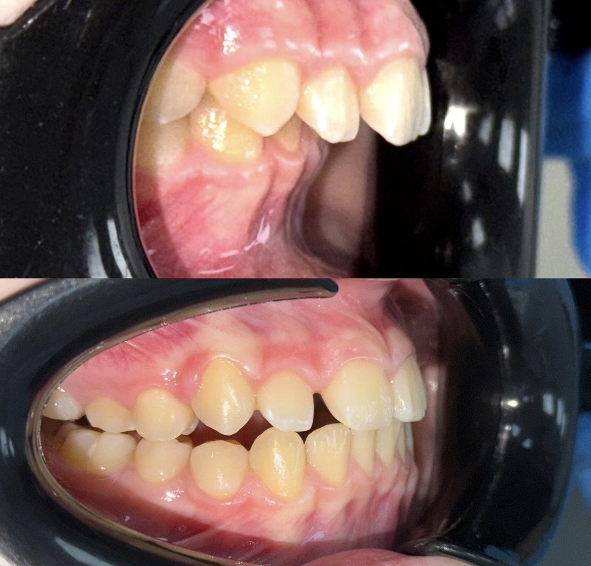 На фото: примеры из практики коррекции дистального прикуса Ксении Пиксайкиной-Григорьевой