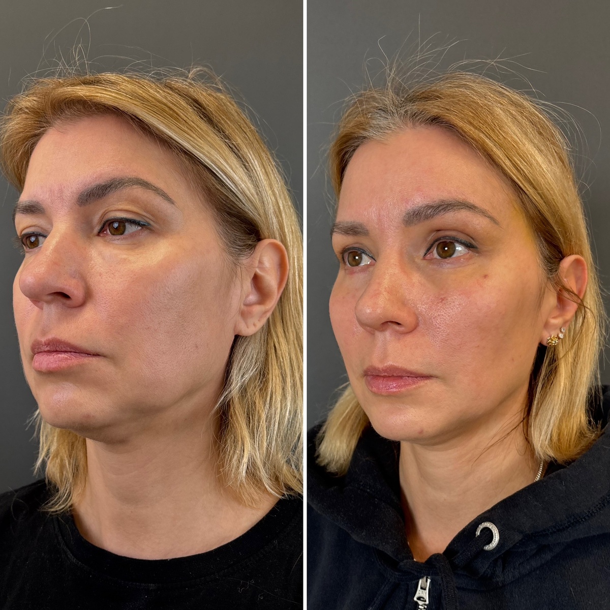 Периорбитопластика и пластика кончика носа: 14 дней после операции ( слева- до, справа- после). Хирург к.м.н. Остринская Т.В.