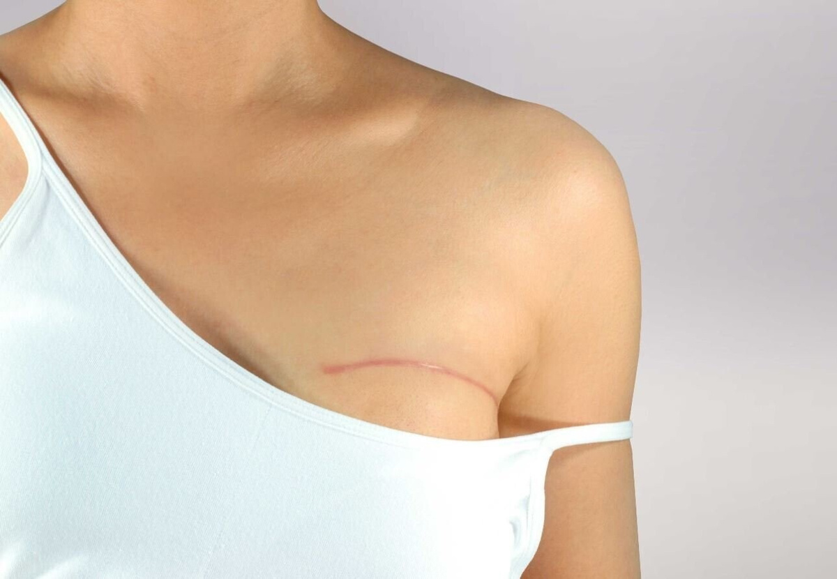 Профилактическая мастэктомия не повышает выживаемость у носителей мутаций BRCA в среднесрочной перспективе