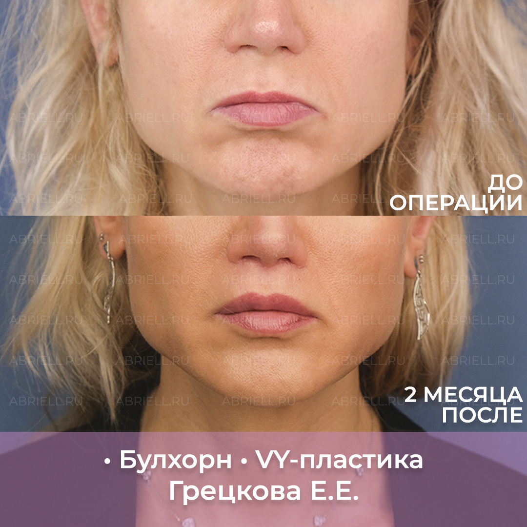 Хейлопластика: Булхорн и VY-пластика. Пластический хирург из Санкт-Петербурга Грецкова Евгения Евгеньевна клиника Абриелль