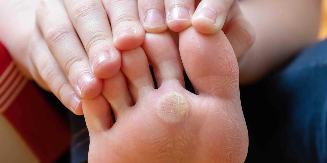 Натоптыши: почему они появляются и как от них избавиться раз и навсегда