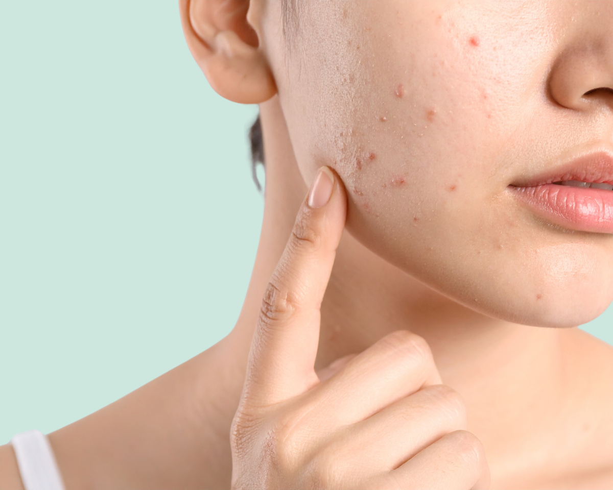 Прыщи после родов