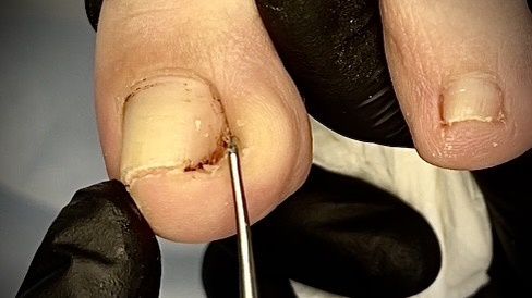 Ноготь скрутился в трубочку