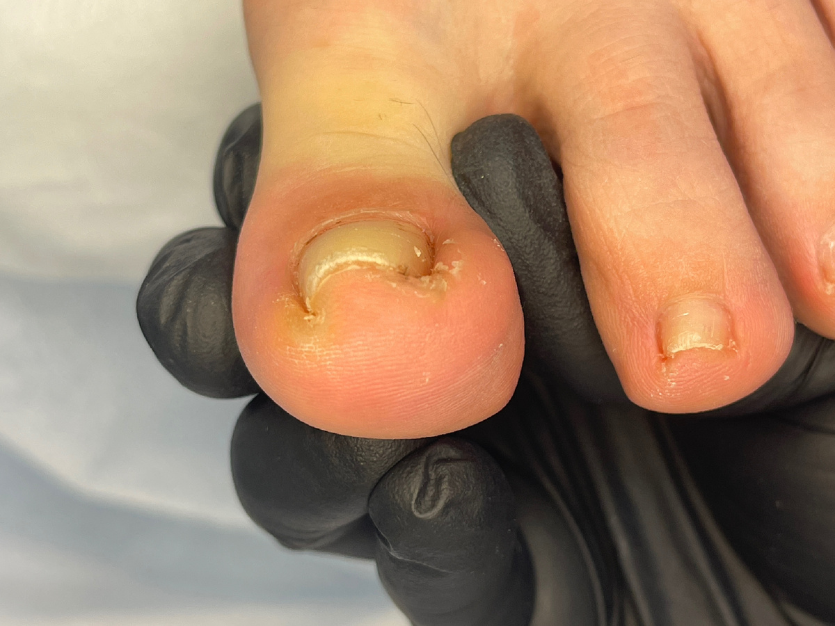 Арочное состояние при котором боковые стенки деформируются и давят в боковых пазухах