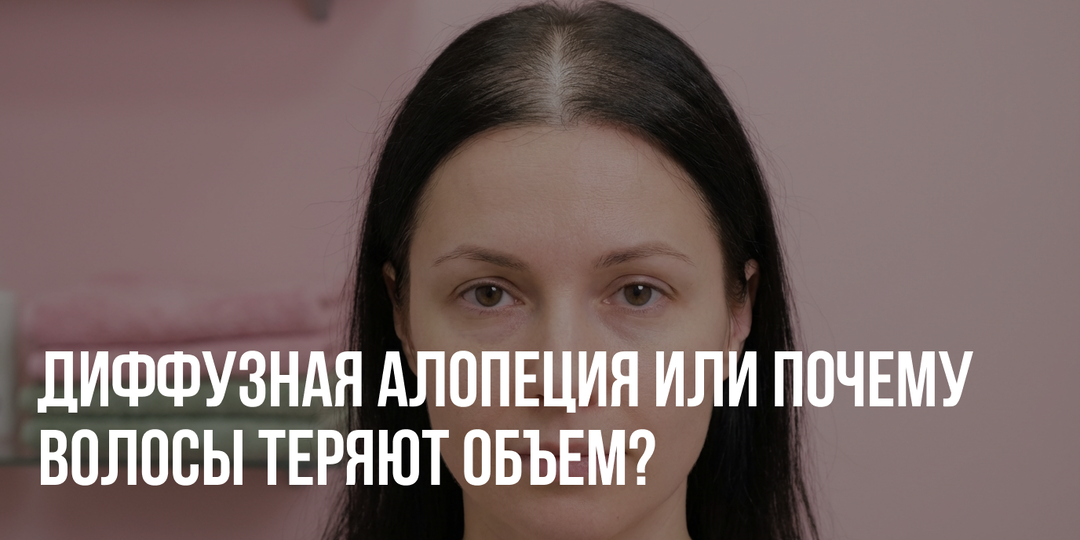Диффузное выпадение волос: причины и восстановление