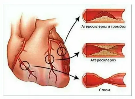 Бляшки показаны в кружках, а ниже, по ходу сосуда, располагается область сердца, которая страдает от недостатка крови.