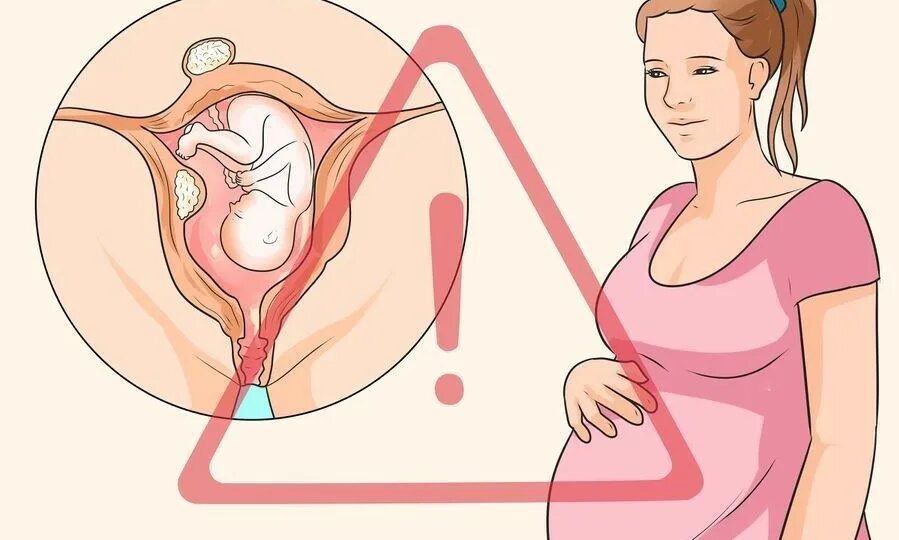 Миома матки во время беременности. Что делать?