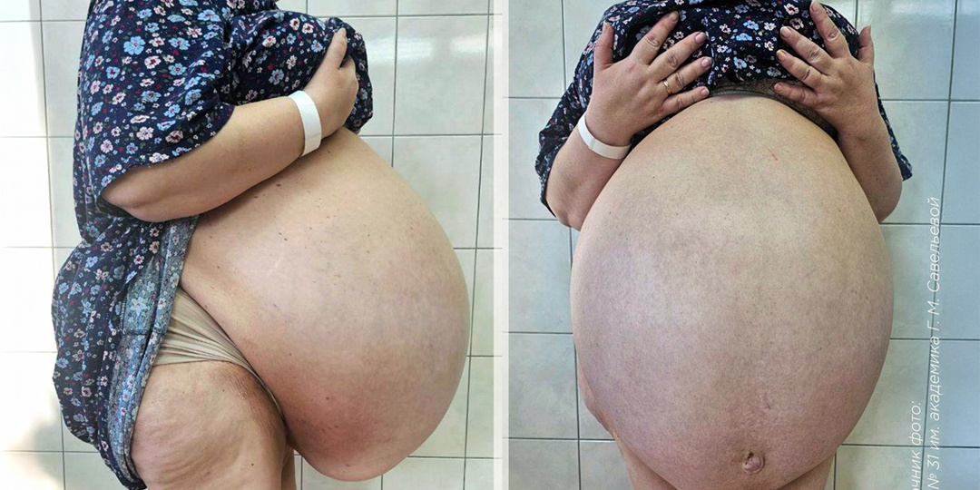 40-литровую кисту печени удалили женщине в больнице Савельевой