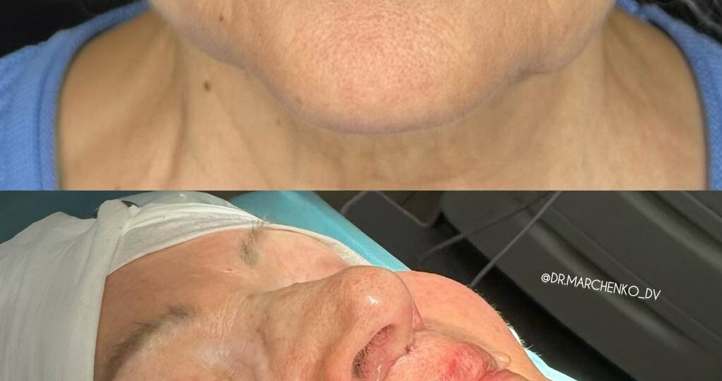 Булхорн (lip lift) — хирургическая методика укорочения расстояния от основания носа до верхней губы