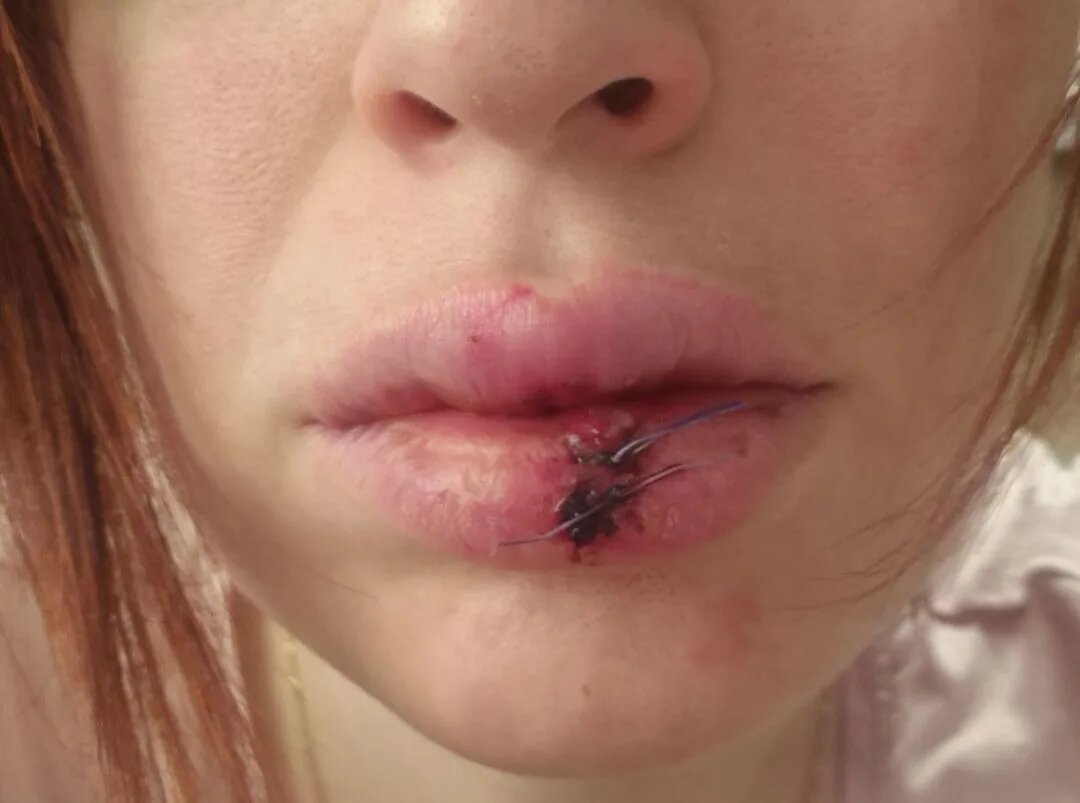 Как будто губы неудачно подкачала