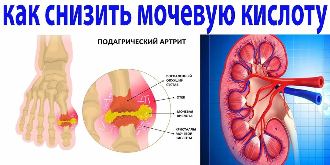 Мочевая кислота: как снизить без таблеток и сложных схем