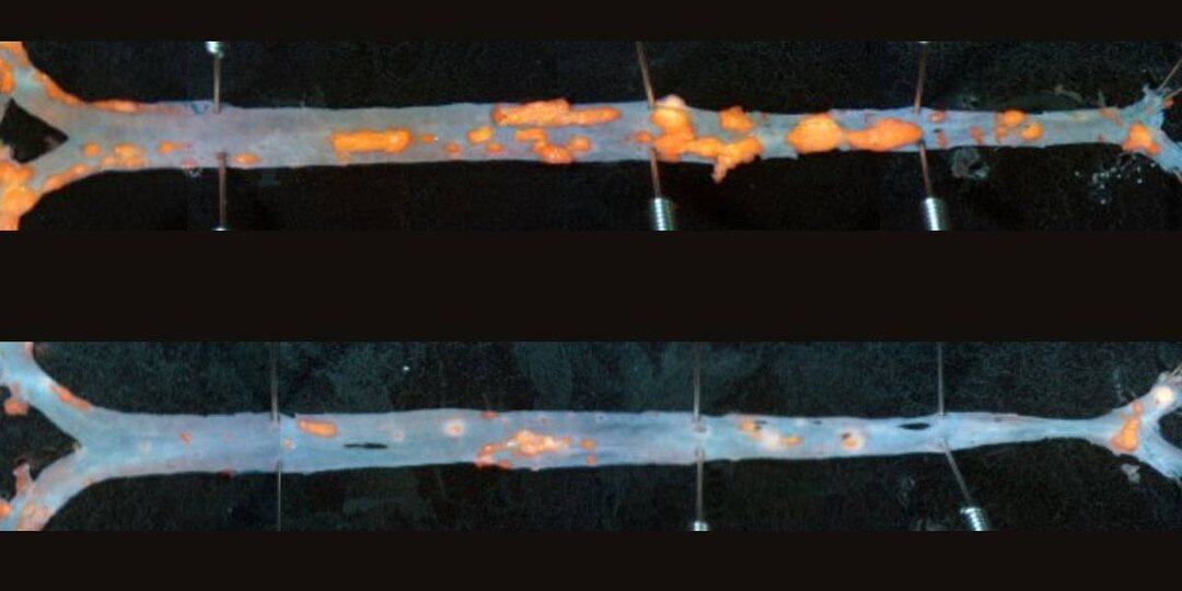 🧬 Иммунотерапия против атеросклероза: Т-клетки научили разрушать бляшки