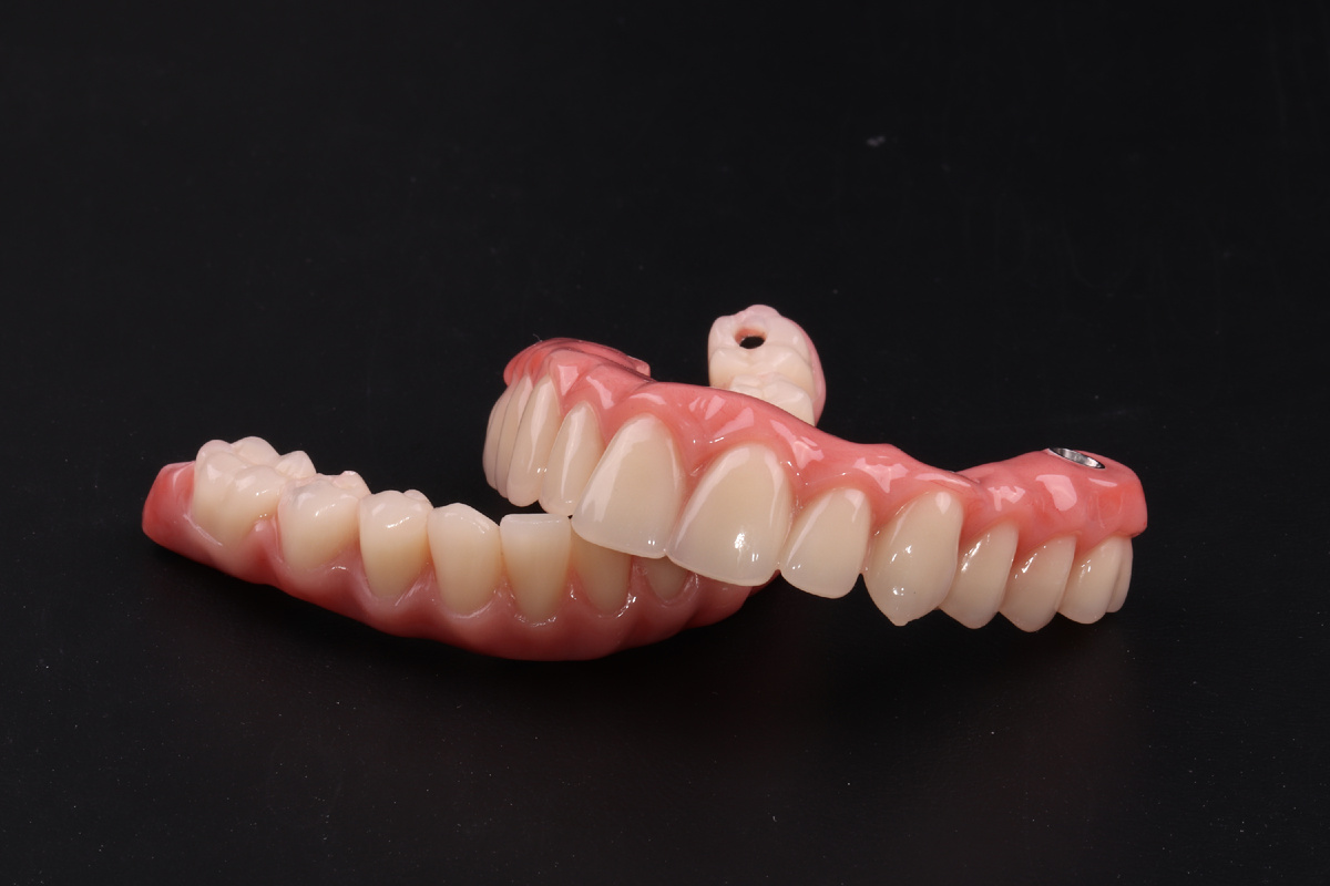 Так выглядит несъёмный протез по методике "Всё-на-6"