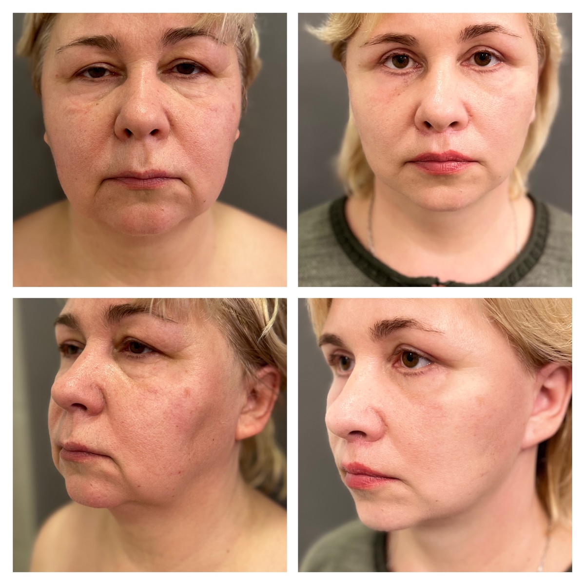 SMAS-лифтинг лица «до» и «после»