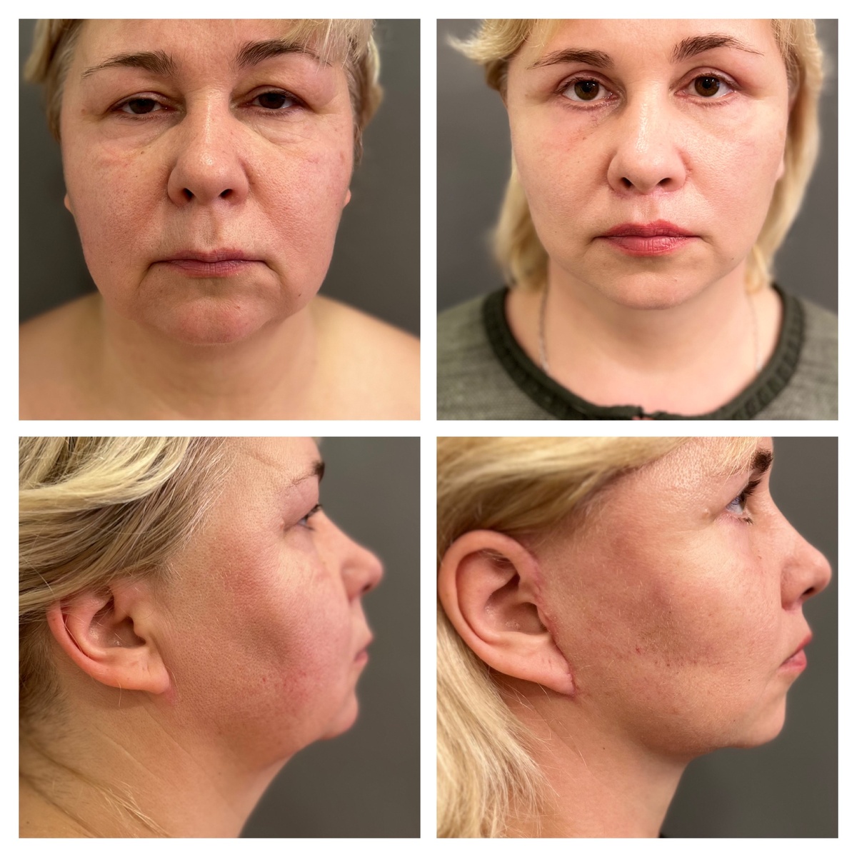 SMAS-лифтинг лица «до» и «после»