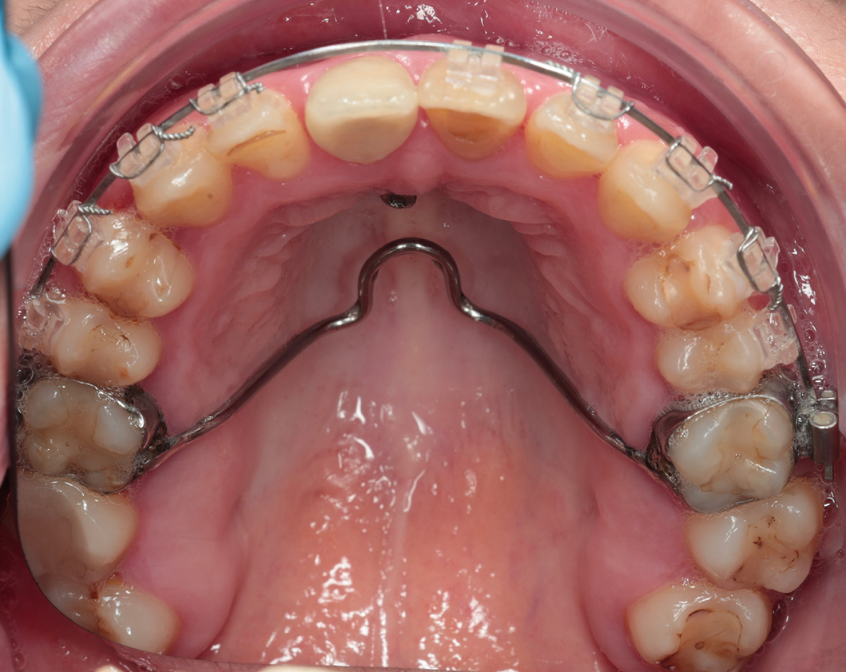 Аппарат на верхней челюсти и "винт" (я не знаю, что это и для чего)