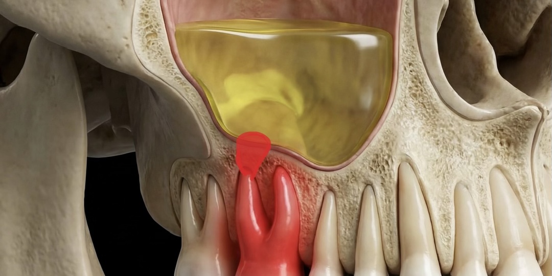 Насморк от больных зубов. Миф или реальность…