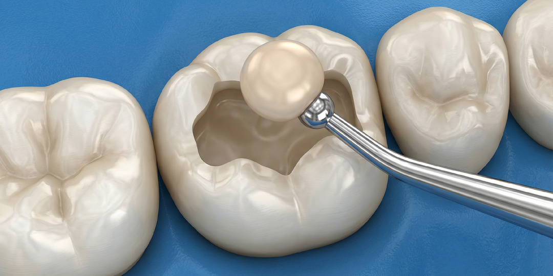 Про пломбу.