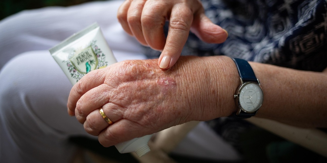 Сахарный диабет: первые симптомы у женщин