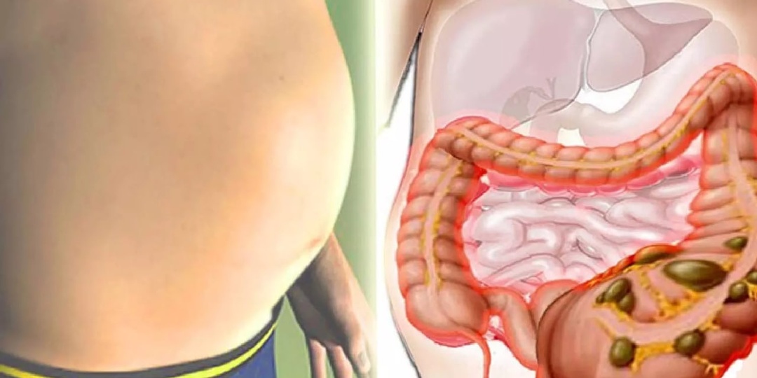 Когда вздутие живота становится тревожным признаком