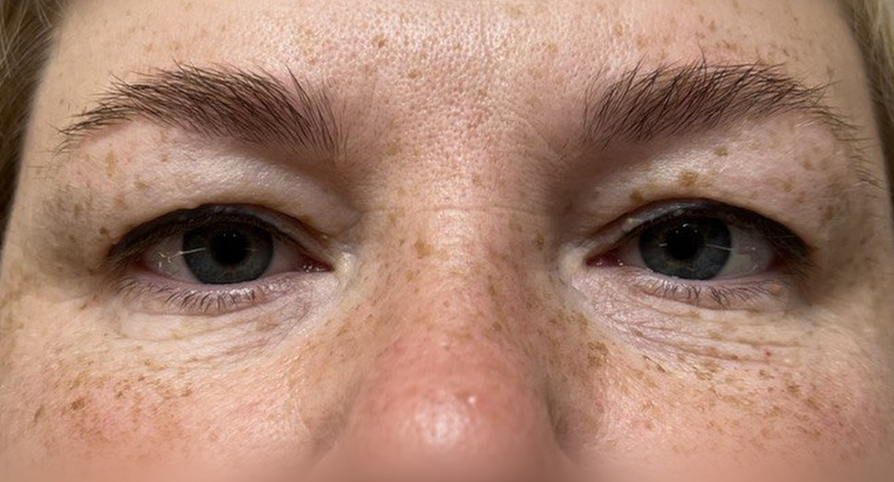 Омолаживающая блефаропластика