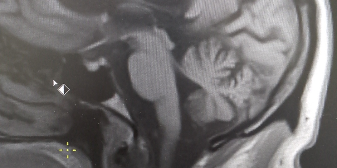 Шатает в стороны, головокружения, падения при ходьбе