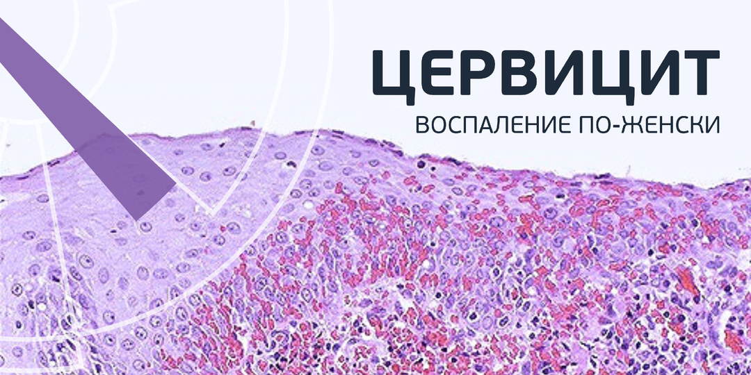 Что такое цервицит и чем он опасен.